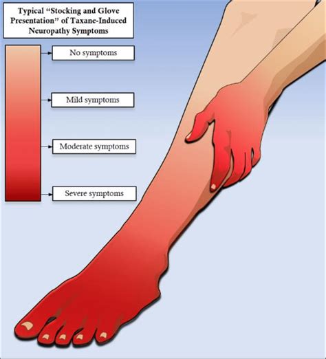 stocking glove syndrome|Stocking & Glove Neuropathy